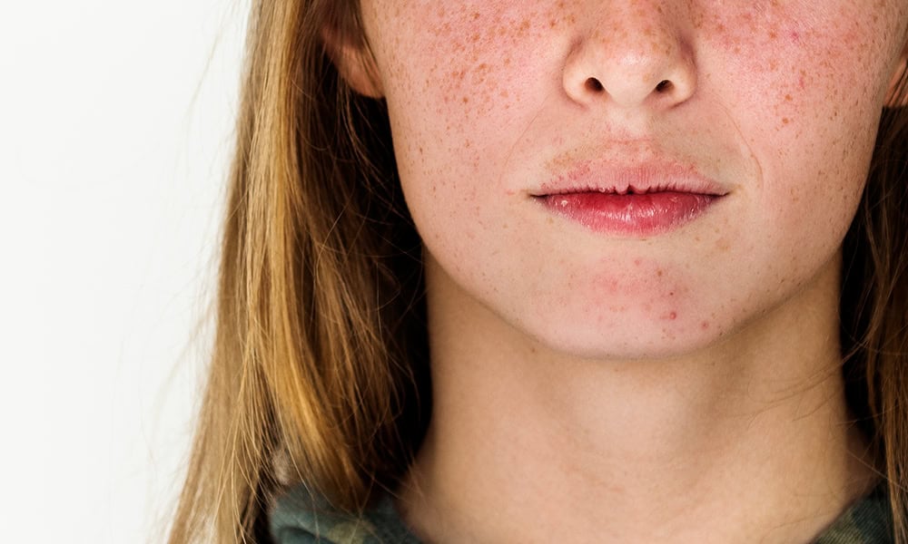 scaderea inflamatiei pielii