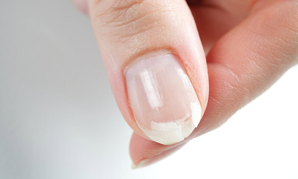 fragilitatea unghiilor